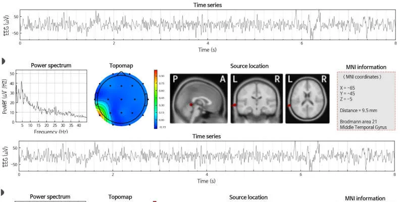 Mapeo Cerebral QEEG